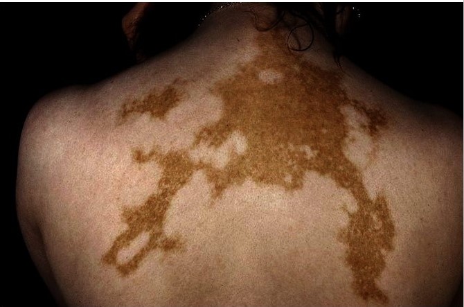 The current view of the problem of vitiligo therapy